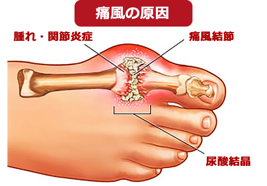 痛風編 症状とお薬ガイド 痛風の原因と治療法を解説 ベストケンコー